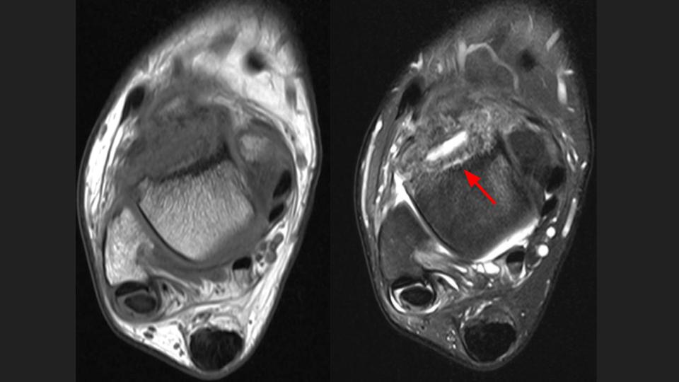 Figure 2 for case Charcot joint ( RID5075 )